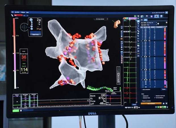MAPA electroanatómico de la Auricular izquierda, utilizando el sistema Precisión - Abbott. Las lesiones (en rojo) creadas utilizando energía por radiofrecuencia, usando los catéteres de última generación Tacti cath. Catéteres con sensores de contacto y temperatura, los cuales permiten la creación de lesiones más duraderas seguras y definitivas.