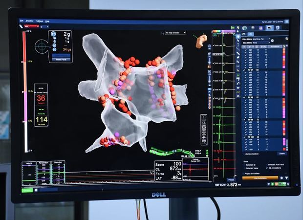 MAPA electroanatómico de la Auricular izquierda, utilizando el sistema Precisión - Abbott. Las lesiones (en rojo) creadas utilizando energía por radiofrecuencia, usando los catéteres de última generación Tacti cath. Catéteres con sensores de contacto y temperatura, los cuales permiten la creación de lesiones más duraderas seguras y definitivas.