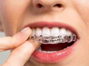 Los dentistas advierten de los peligros de la ortodoncia invisible que publicitan muchos influencers