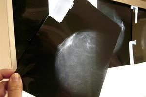 Identifican una pieza del "rompecabezas" del cáncer de mama que explicaría ciertos tipos