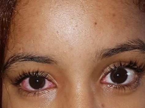 Adolescente infectada con conjuntivitis.