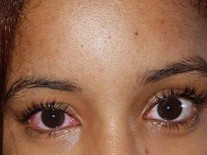 La República Dominicana reporta más de 93.000 casos de conjuntivitis este año