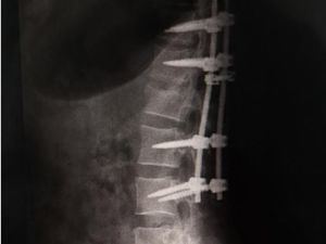 Cirujanos del Gautier esperanzados tras cirugí­a a mujer sufrió fractura columna