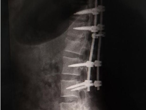 Imagen después de cirugía lumbar.