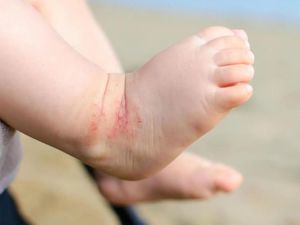 La dermatitis atópica afecta a más del 50% de los niños que visitan a un especialista de la piel en RD