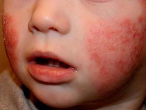 La dermatitis atópica afecta a más del 50% de los niños que visitan a un especialista de la piel en RD