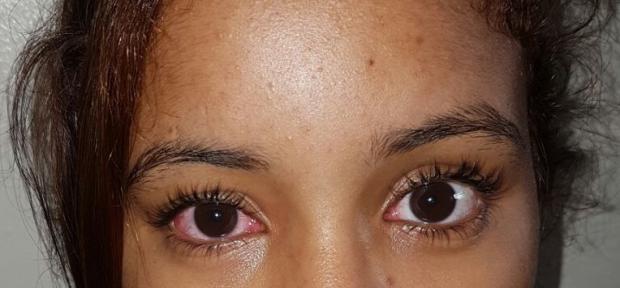 Adolescente infectada con conjuntivitis.
