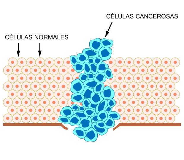 El cáncer, segunda enfermedad más mortal en la República Dominicana 