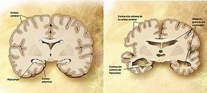 Cerebro corte frontal Alzheimer.