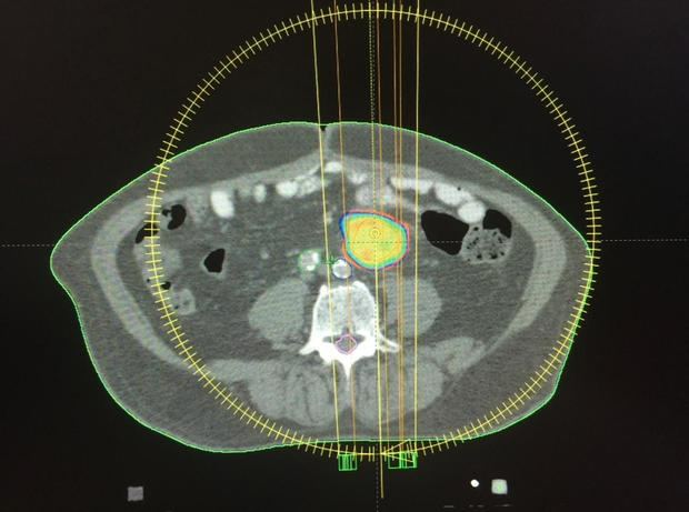 Radiocirugía intracraneal.