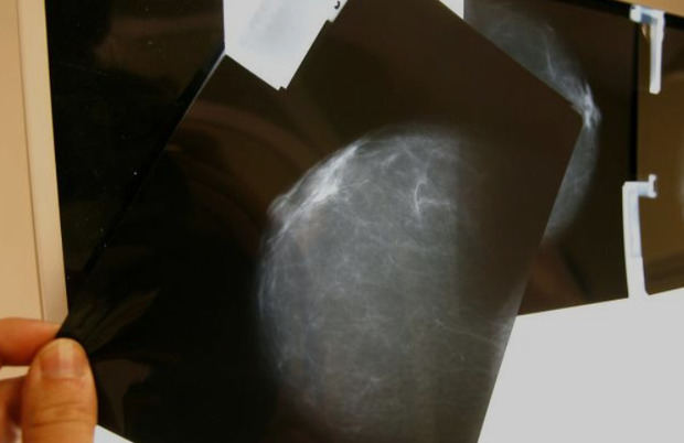 Detalle de una prueba radiológica de detección precoz del cáncer de mama.