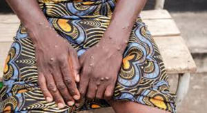 La OMS pide una ayuda de 135 millones de dólares para frenar los brotes de mpox en África