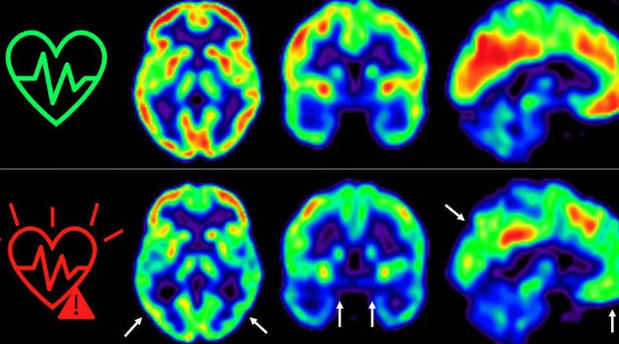 Empezar cuanto antes a cuidar la salud cardiovascular es bueno también para el cerebro.