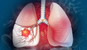 Sociedad Oncología Médica: 80% cáncer pulmón se asocia al tabaco