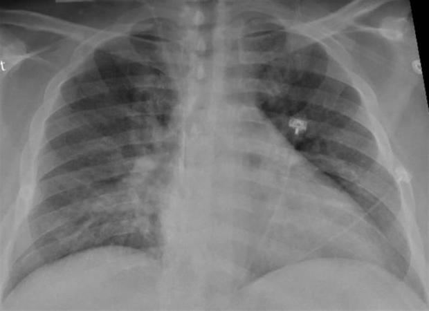 Radiografía de tórax de un paciente de SARS-CoV-2 que muestra debilidad en el lado izquierdo y una neumonía en la parte inferior de los pulmones.