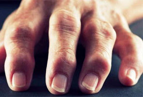 Necesitas saberlo: estrenan nueva tecnolog&#237;a para reducir dolor por artritis en los dedos