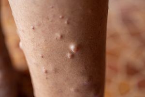 Koselugo: nuevo tratamiento que reduce tumores en pacientes con Neurofibromatosis Tipo 1 