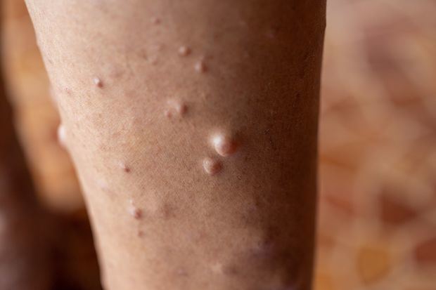 Koselugo: nuevo tratamiento que reduce tumores en pacientes con Neurofibromatosis Tipo 1 