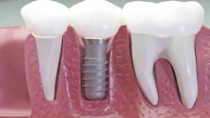 Celebran jornada de implantes dentales