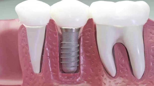 Celebran jornada de implantes dentales