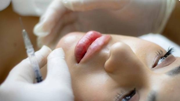 Aumento de labios: naturalidad ante todo.