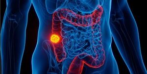 Cáncer de colon: alto riesgo en República Dominicana