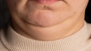 Cuello grueso: alerta de riesgos metabólicos