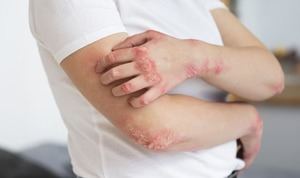Un tratamiento temprano puede cambiar el curso de la psoriasis y prevenir daños articulares irreversibles