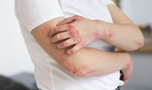 Un tratamiento temprano puede cambiar el curso de la psoriasis y prevenir daños articulares irreversibles.