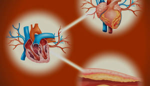 Obstrucciones en las arterias pueden causar infartos sin previo aviso, advierte cardiólogo
